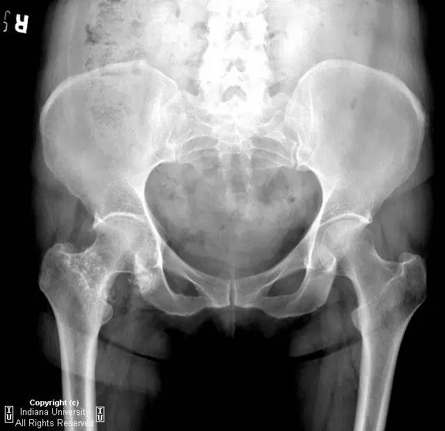 【病例】髋关节滑膜骨软骨瘤病1例X线及MR影像表现 【病例】髋关节滑膜骨软骨瘤病1例X线及MR影像表现