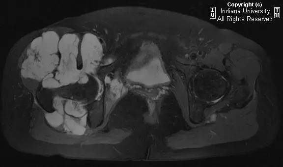 【病例】髋关节滑膜骨软骨瘤病1例X线及MR影像表现 【病例】髋关节滑膜骨软骨瘤病1例X线及MR影像表现