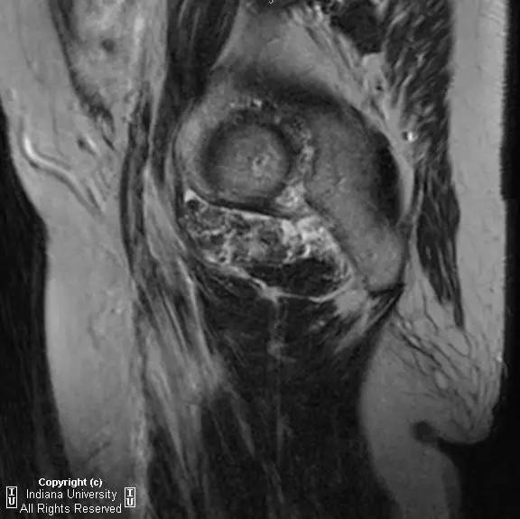 【病例】髋关节滑膜骨软骨瘤病1例X线及MR影像表现 【病例】髋关节滑膜骨软骨瘤病1例X线及MR影像表现