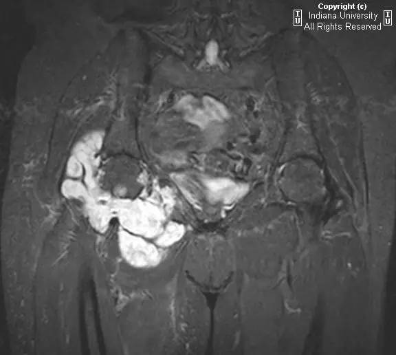 【病例】髋关节滑膜骨软骨瘤病1例X线及MR影像表现 【病例】髋关节滑膜骨软骨瘤病1例X线及MR影像表现