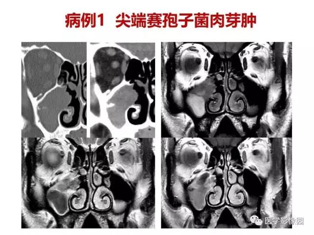 【PPT】鼻腔鼻窦肿瘤与肿瘤样病变的影像学诊断分析思路
