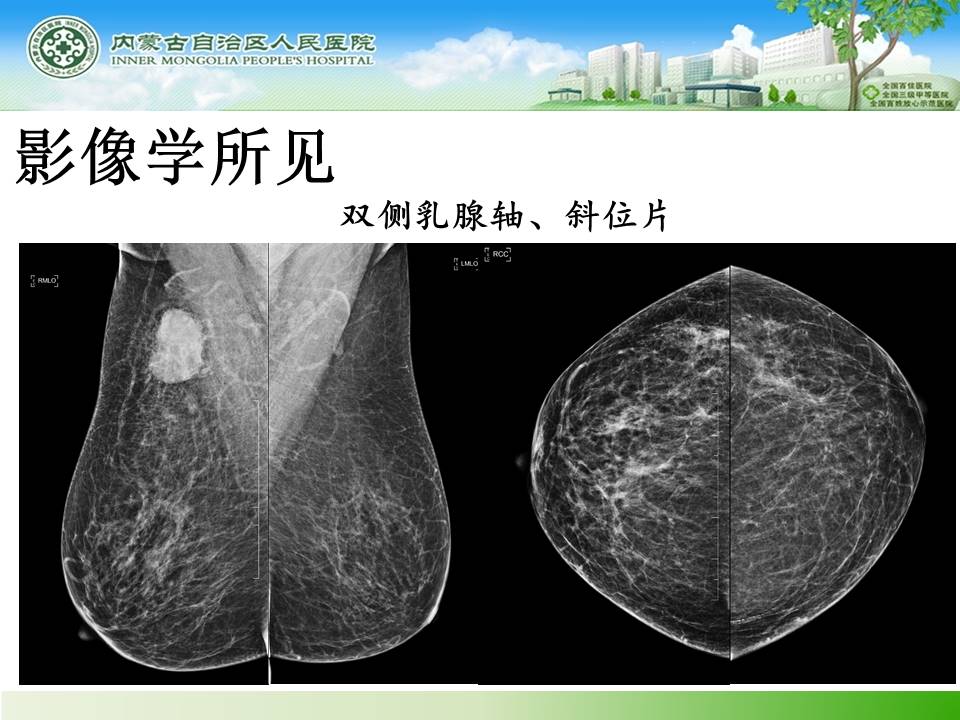 【病例】乳腺转移瘤1例X线钼靶