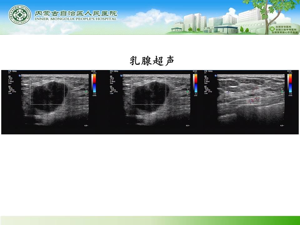 【病例】乳腺转移瘤1例X线钼靶