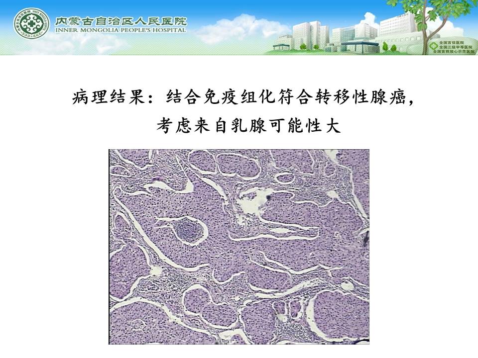 【病例】乳腺转移瘤1例X线钼靶