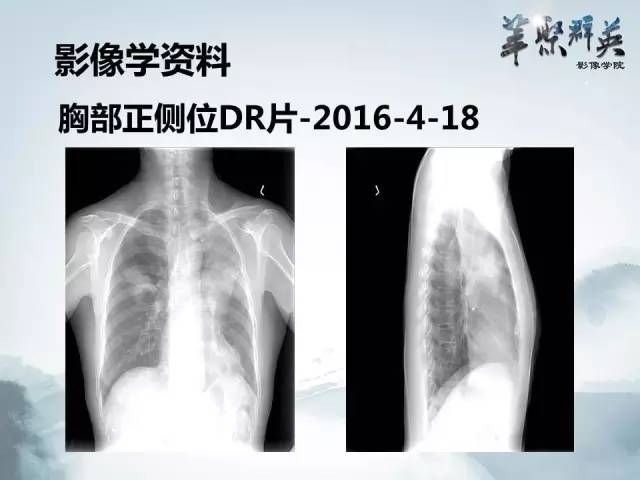 【病例】不典型肺癌1例CT影像表现