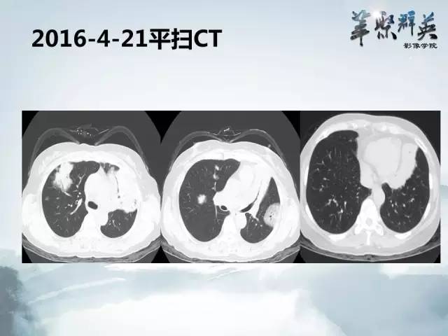 【病例】不典型肺癌1例CT影像表现