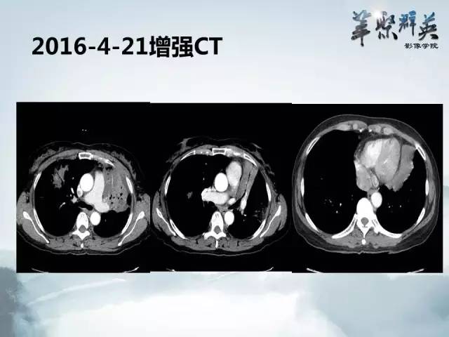 【病例】不典型肺癌1例CT影像表现