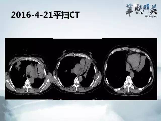 【病例】不典型肺癌1例CT影像表现