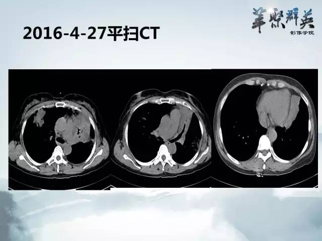【病例】不典型肺癌1例CT影像表现