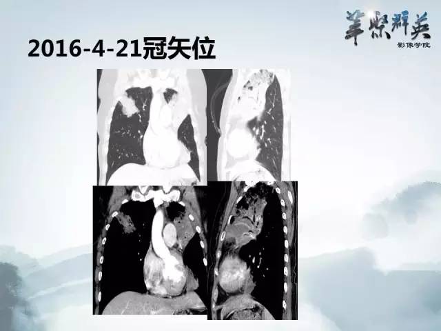 【病例】不典型肺癌1例CT影像表现