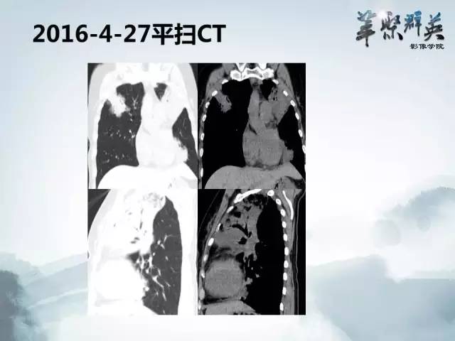 【病例】不典型肺癌1例CT影像表现