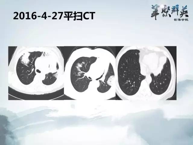 【病例】不典型肺癌1例CT影像表现