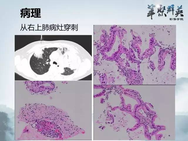 【病例】不典型肺癌1例CT影像表现