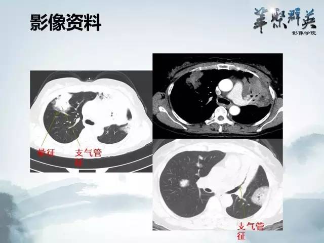 【病例】不典型肺癌1例CT影像表现