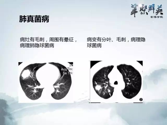【病例】不典型肺癌1例CT影像表现