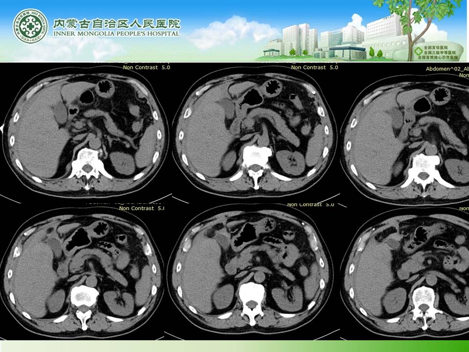 【病例】肝腺瘤1例CT