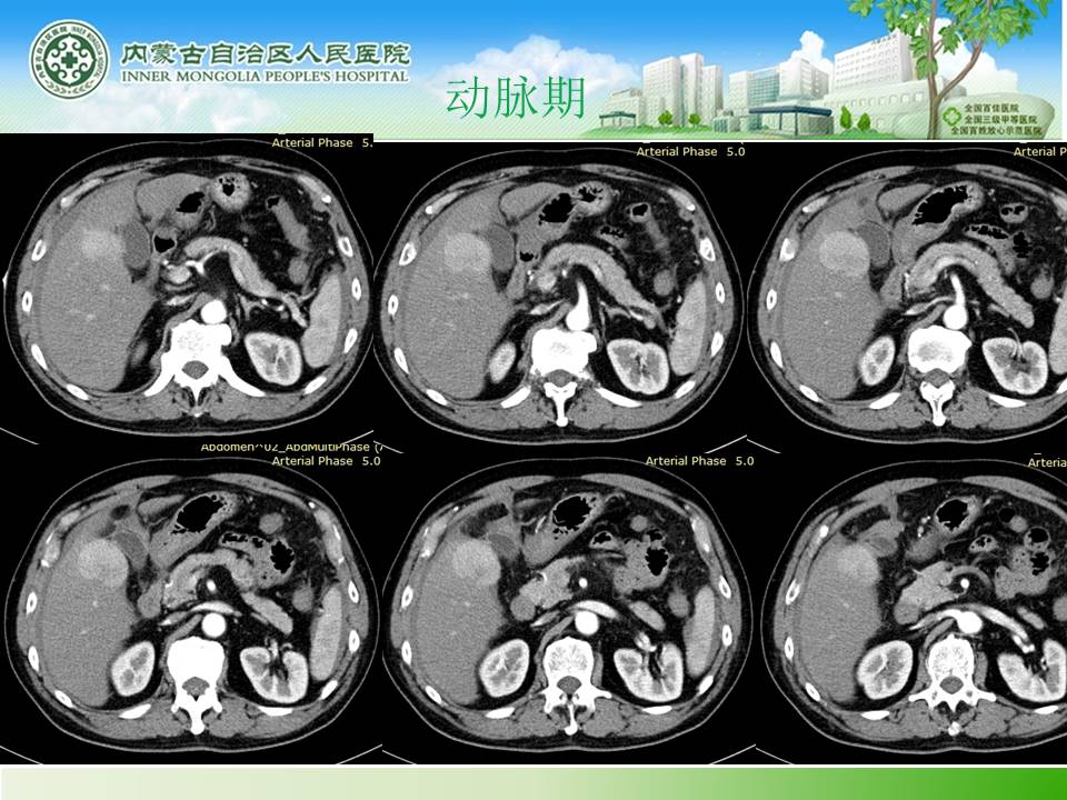【病例】肝腺瘤1例CT