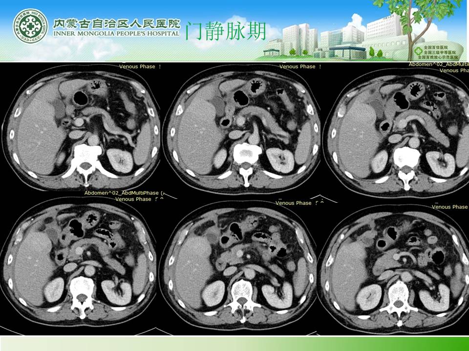 【病例】肝腺瘤1例CT