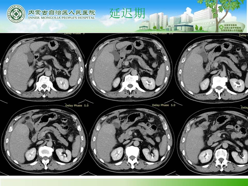 【病例】肝腺瘤1例CT