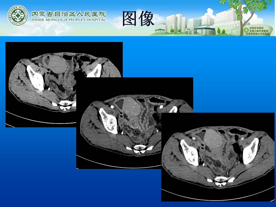 【病例】小肠淋巴瘤1例CT