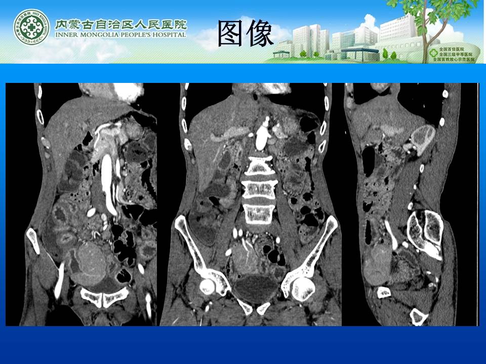 【病例】小肠淋巴瘤1例CT
