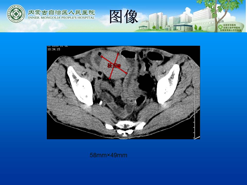【病例】小肠淋巴瘤1例CT