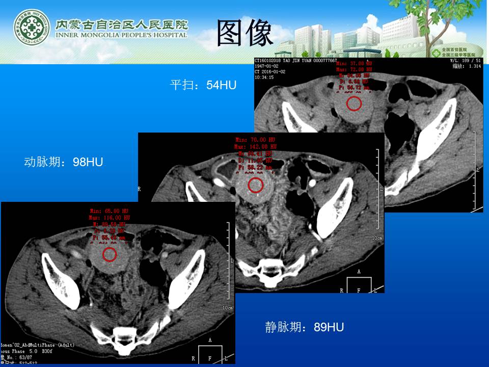 【病例】小肠淋巴瘤1例CT