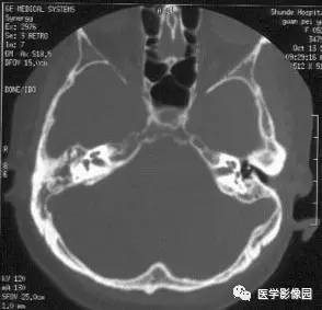 中耳癌 cancer of the middle ear 中耳癌 cancer of the middle ear