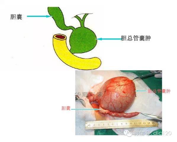 先天性胆管扩张症