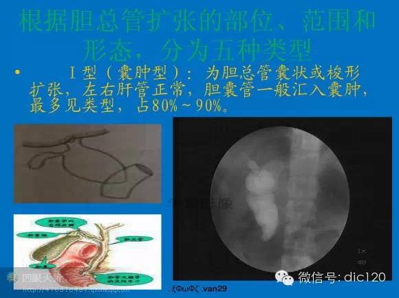 先天性胆管扩张症