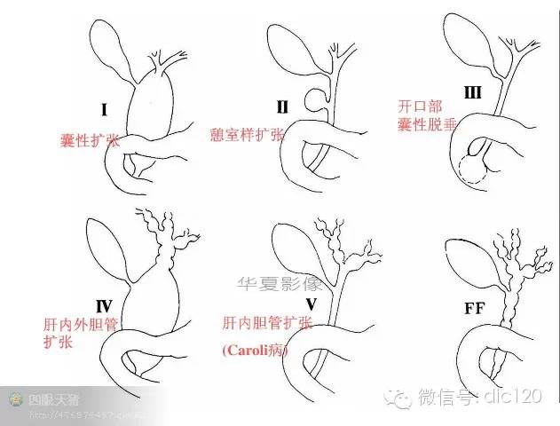 先天性胆管扩张症