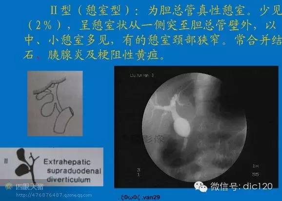 先天性胆管扩张症