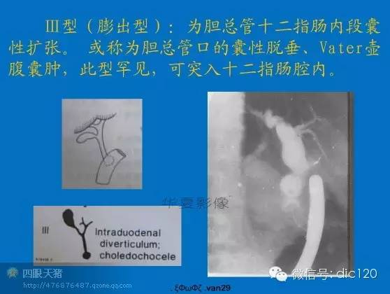 先天性胆管扩张症