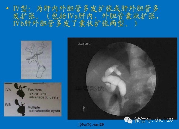 先天性胆管扩张症