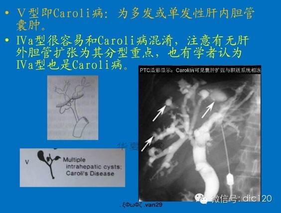 先天性胆管扩张症
