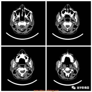 【病例】椎管内哑铃状肿块——神经鞘瘤1例MR影像表现 【病例】椎管内哑铃状肿块——神经鞘瘤1例MR影像表现