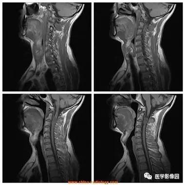 【病例】椎管内哑铃状肿块——神经鞘瘤1例MR影像表现 【病例】椎管内哑铃状肿块——神经鞘瘤1例MR影像表现