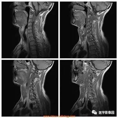 【病例】椎管内哑铃状肿块——神经鞘瘤1例MR影像表现 【病例】椎管内哑铃状肿块——神经鞘瘤1例MR影像表现