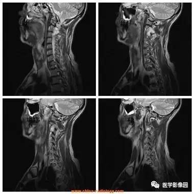 【病例】椎管内哑铃状肿块——神经鞘瘤1例MR影像表现 【病例】椎管内哑铃状肿块——神经鞘瘤1例MR影像表现