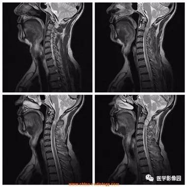 【病例】椎管内哑铃状肿块——神经鞘瘤1例MR影像表现 【病例】椎管内哑铃状肿块——神经鞘瘤1例MR影像表现