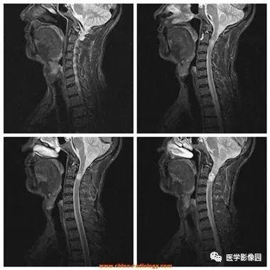【病例】椎管内哑铃状肿块——神经鞘瘤1例MR影像表现 【病例】椎管内哑铃状肿块——神经鞘瘤1例MR影像表现
