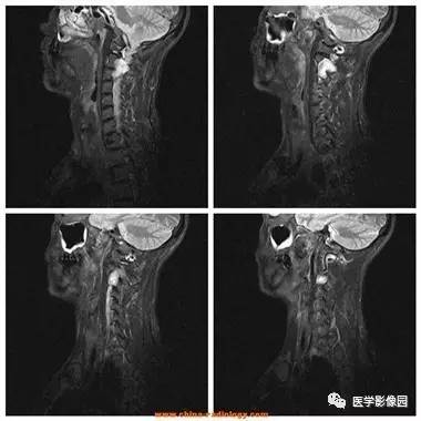【病例】椎管内哑铃状肿块——神经鞘瘤1例MR影像表现 【病例】椎管内哑铃状肿块——神经鞘瘤1例MR影像表现