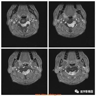 【病例】椎管内哑铃状肿块——神经鞘瘤1例MR影像表现 【病例】椎管内哑铃状肿块——神经鞘瘤1例MR影像表现