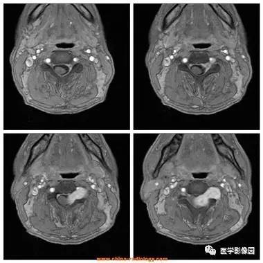 【病例】椎管内哑铃状肿块——神经鞘瘤1例MR影像表现 【病例】椎管内哑铃状肿块——神经鞘瘤1例MR影像表现