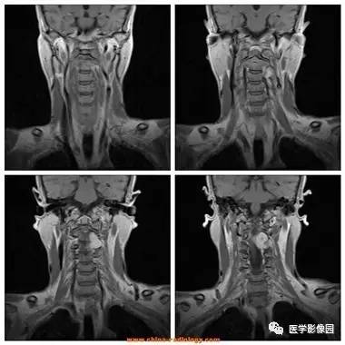 【病例】椎管内哑铃状肿块——神经鞘瘤1例MR影像表现 【病例】椎管内哑铃状肿块——神经鞘瘤1例MR影像表现