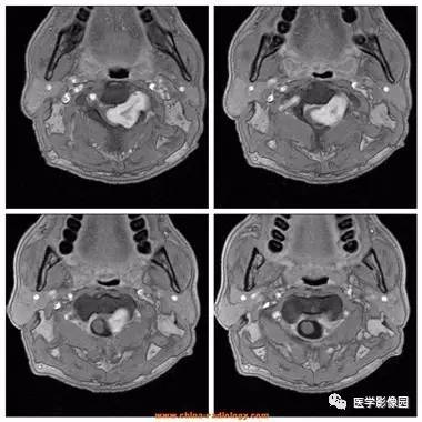 【病例】椎管内哑铃状肿块——神经鞘瘤1例MR影像表现 【病例】椎管内哑铃状肿块——神经鞘瘤1例MR影像表现