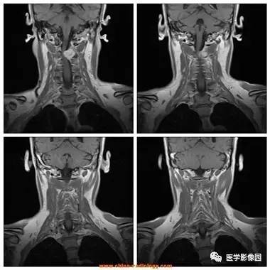 【病例】椎管内哑铃状肿块——神经鞘瘤1例MR影像表现 【病例】椎管内哑铃状肿块——神经鞘瘤1例MR影像表现