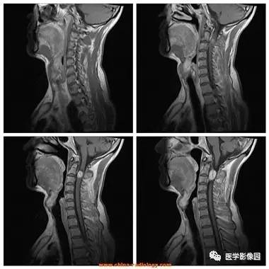 【病例】椎管内哑铃状肿块——神经鞘瘤1例MR影像表现 【病例】椎管内哑铃状肿块——神经鞘瘤1例MR影像表现