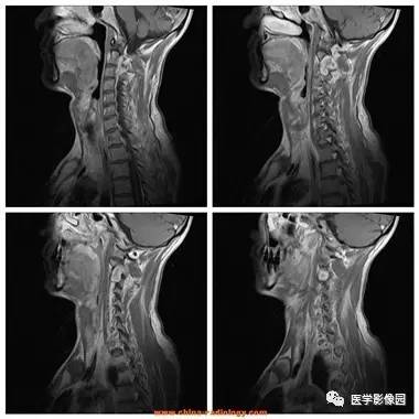 【病例】椎管内哑铃状肿块——神经鞘瘤1例MR影像表现 【病例】椎管内哑铃状肿块——神经鞘瘤1例MR影像表现