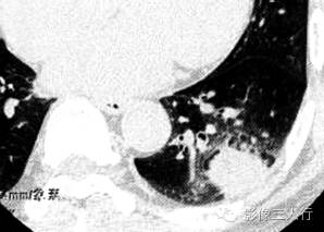 【病例】肺炎性肌纤维母细胞瘤1例CT影像表现 【病例】肺炎性肌纤维母细胞瘤1例CT影像表现